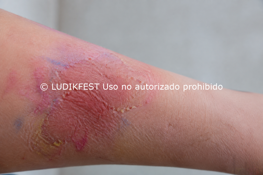 Recreación de reacción cutánea tras utilizar maquillaje inadecuado